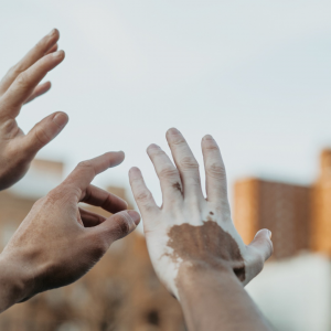Vitiligo: SES-AM faz aviso para alto número de casos no Estado