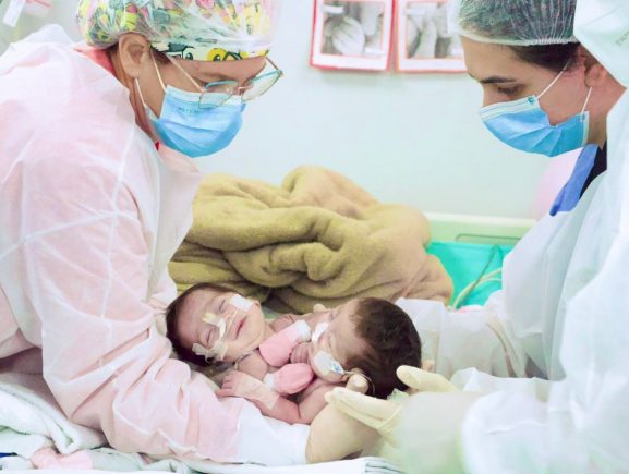 Cirurgia de separação das gêmeas siamesas nascidas no Amazonas é bem-sucedida