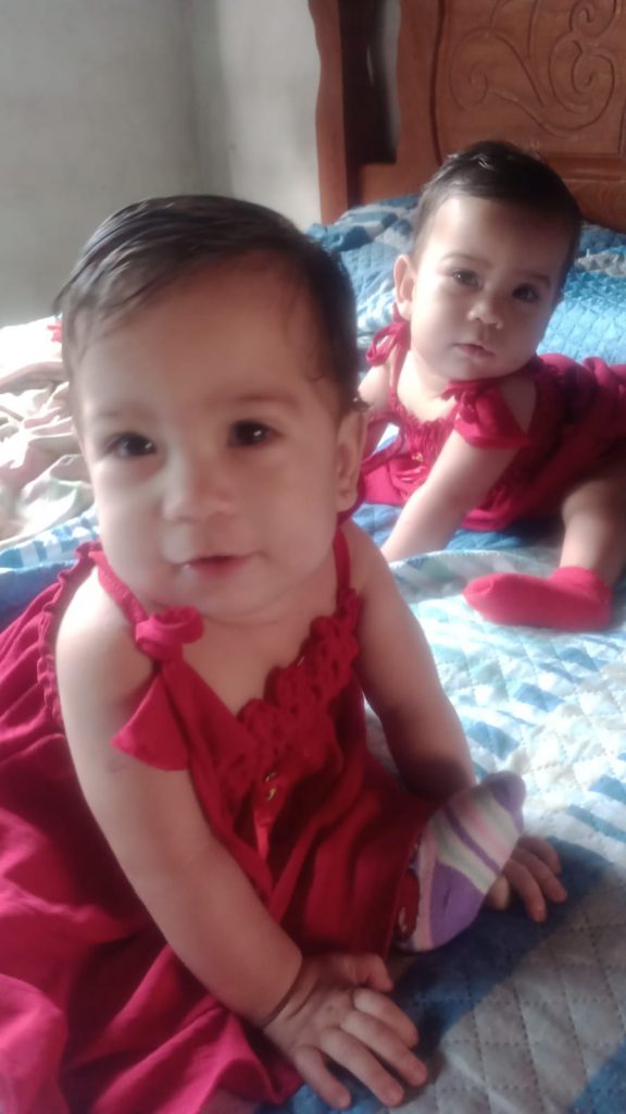 Gemeas siamesas completam 1 ano Foto Divulgacao SES AM 1