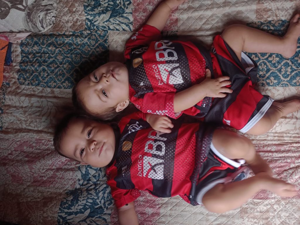 Gemeas siamesas completam 1 ano Foto Divulgacao SES AM 2